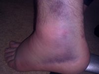 Foot 3 days later.jpg